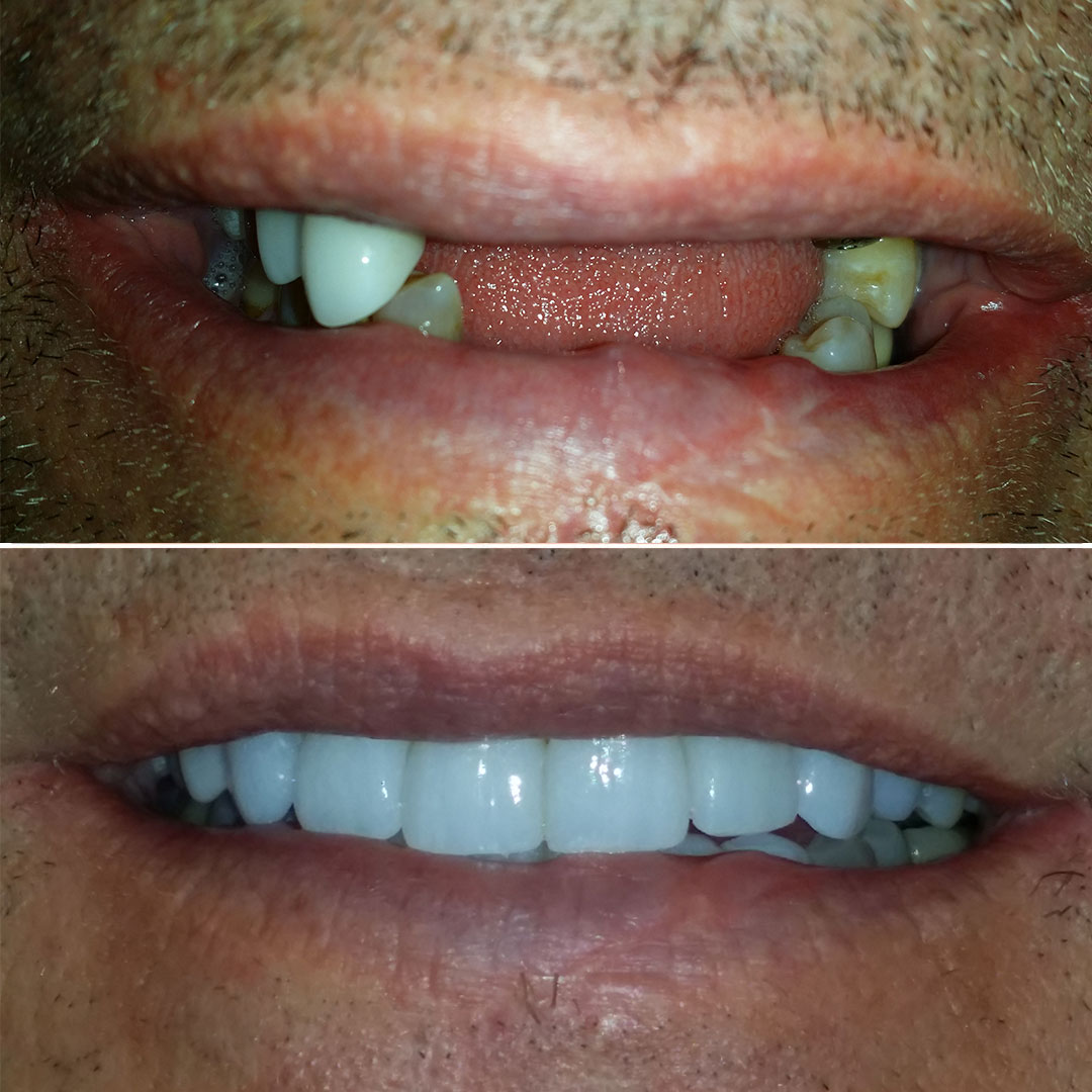 before and after dental implants in san diego