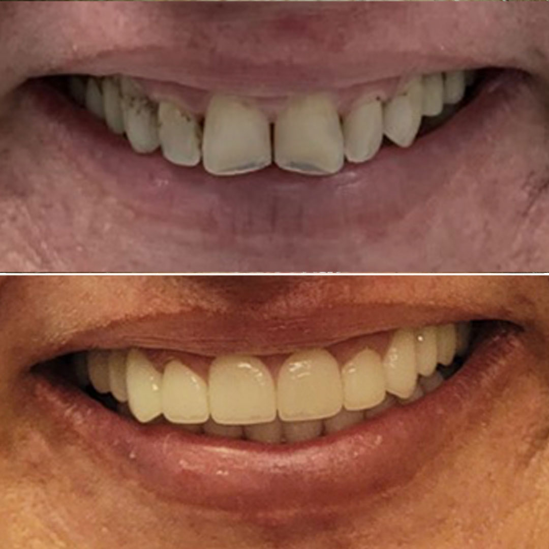 before and after dental implants in san diego