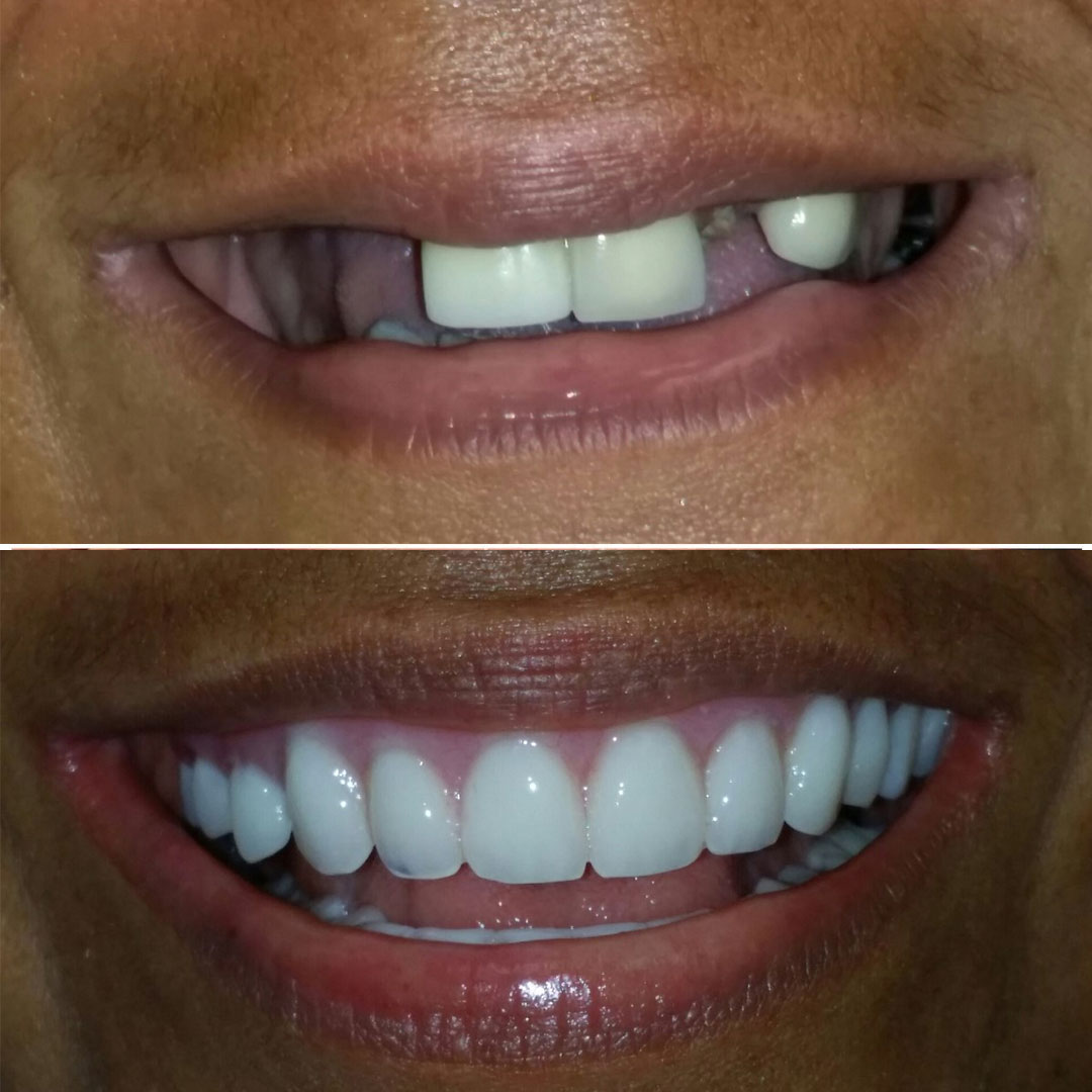 before and after dental implants in san diego