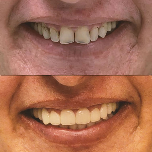 before and after dental implants in san diego